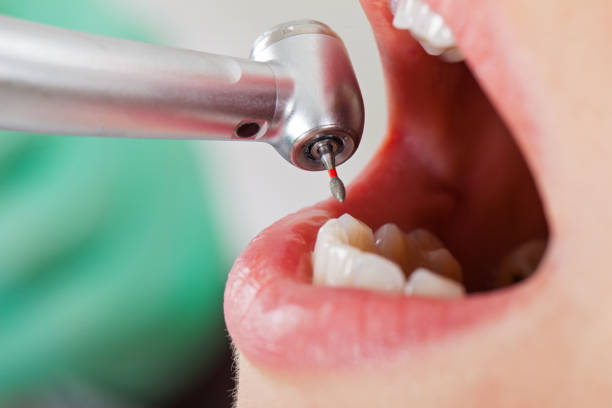 Best Emergency Tooth Extraction in Carnesville, GA